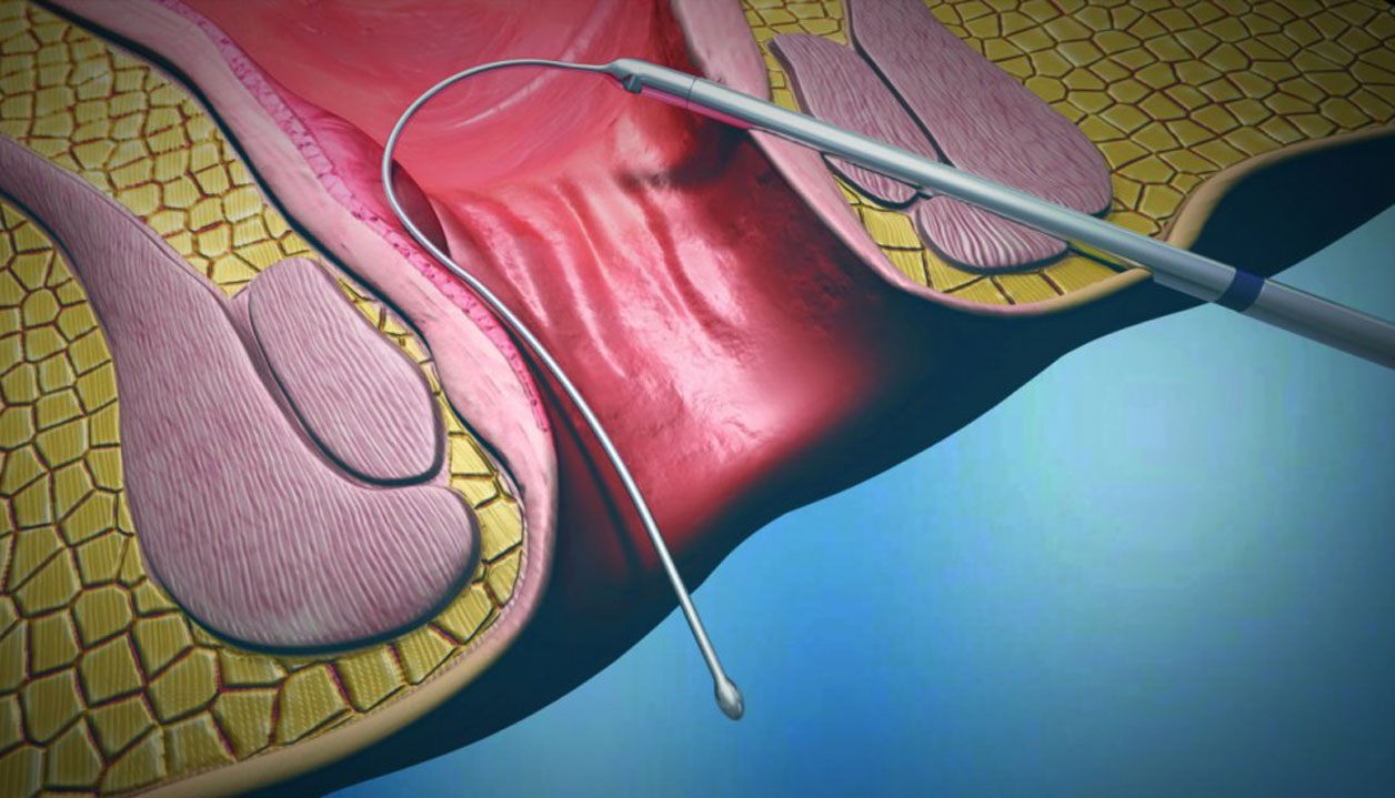 Fistula Prob